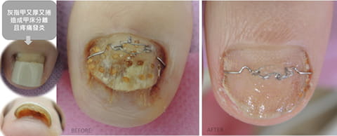 灰指甲+捲甲治療7個月