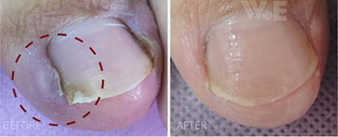 甲溝炎趾肉整形+矯正