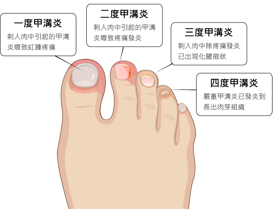 甲溝炎(凍甲)分成4個階段,你屬於哪一種?