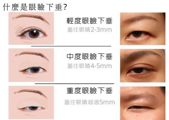 眼瞼下垂的判斷與角膜遮蓋程度分級說明