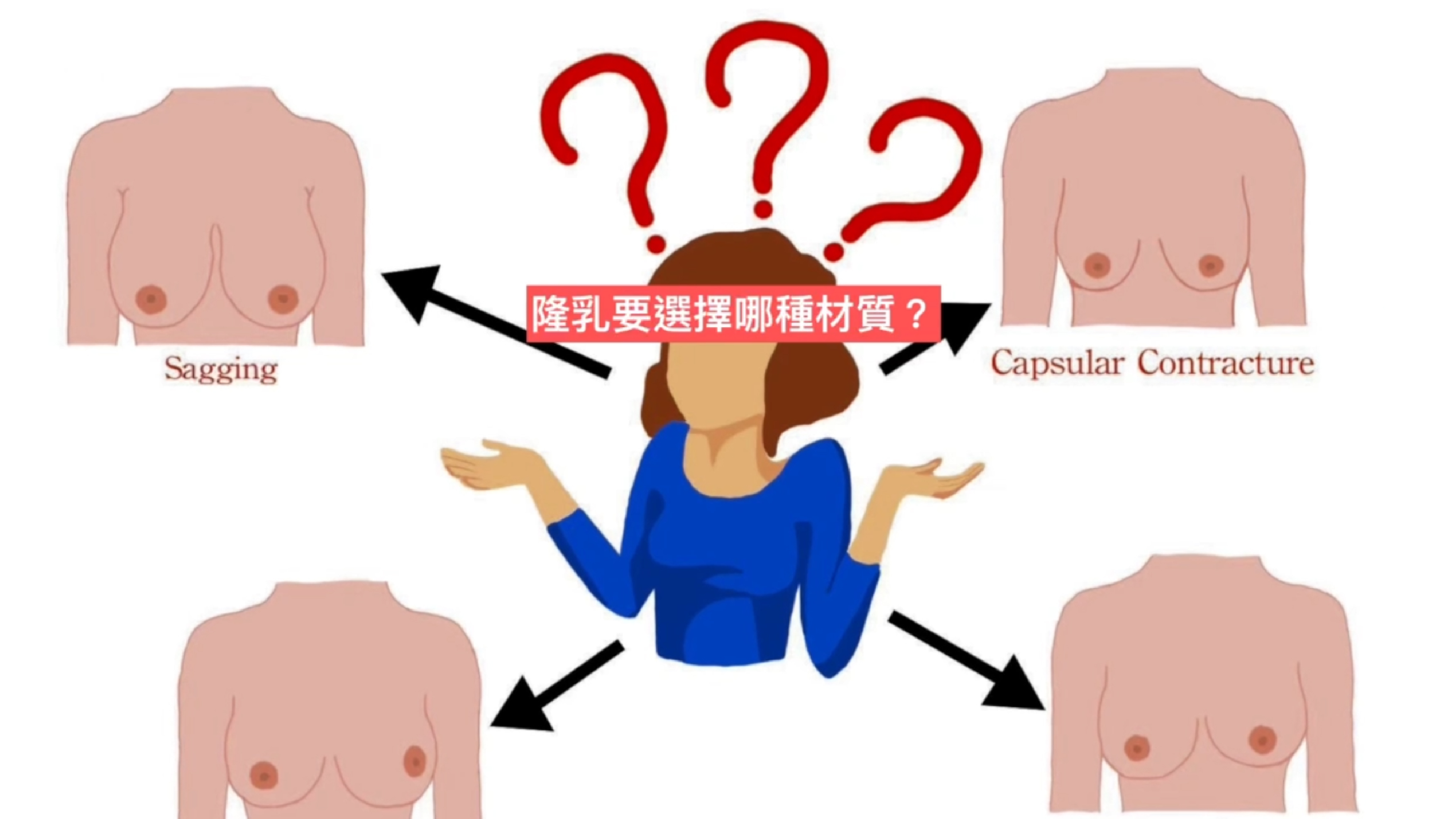 女王波Up植體外觀2