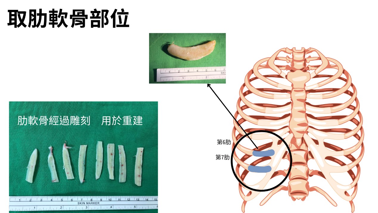 取肋軟骨部位