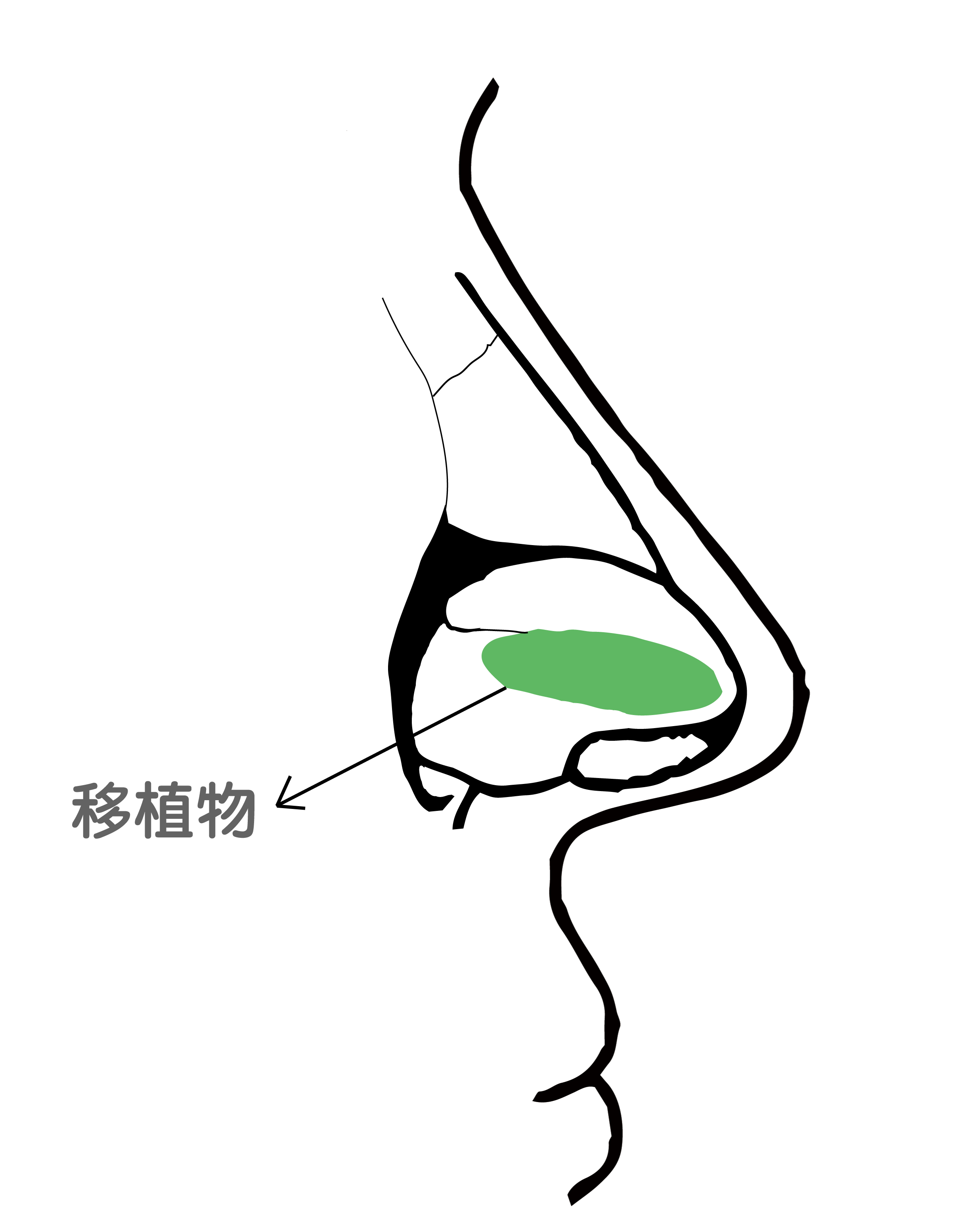 耳複合移植物