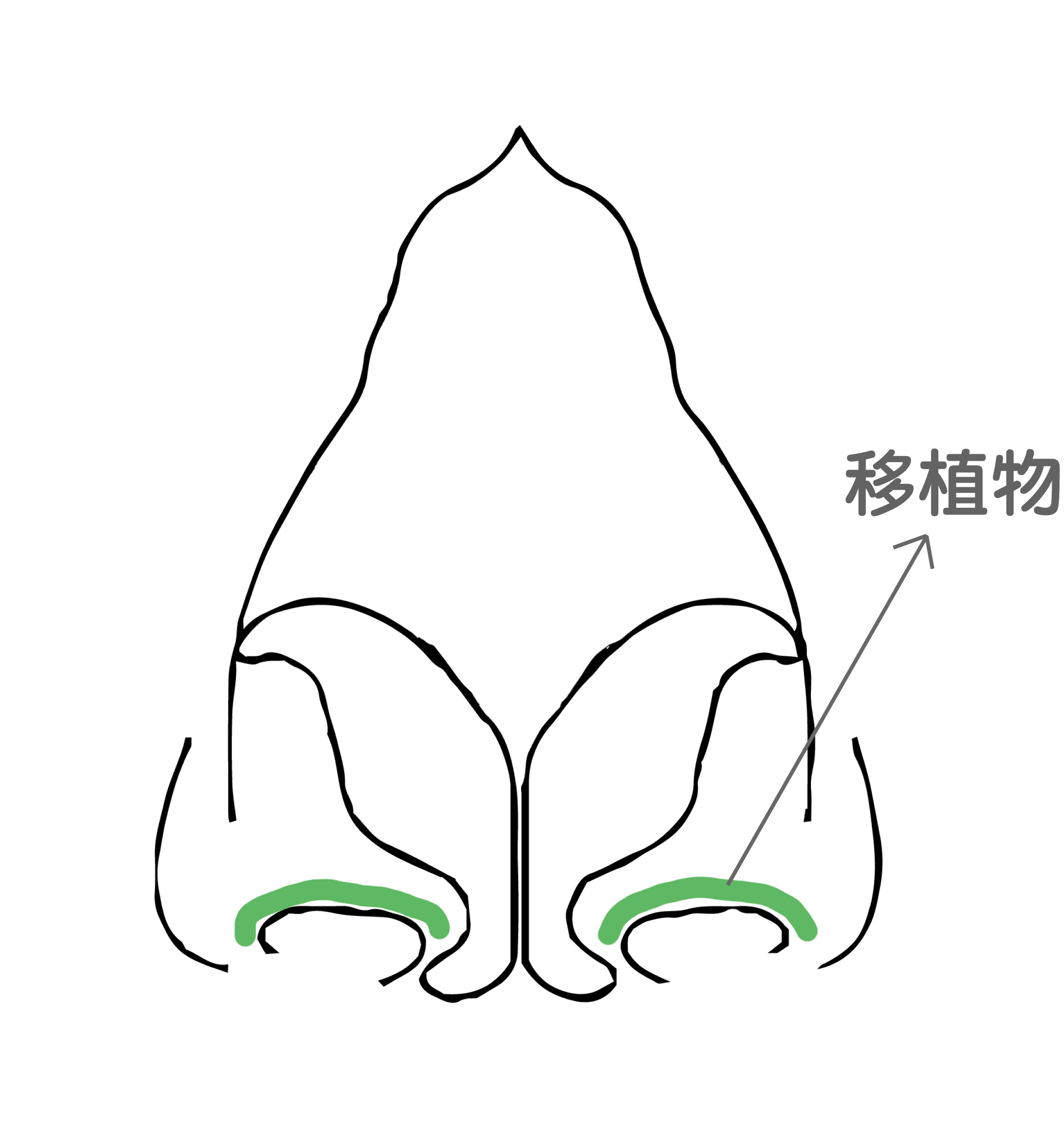 鼻翼輪廓移植術