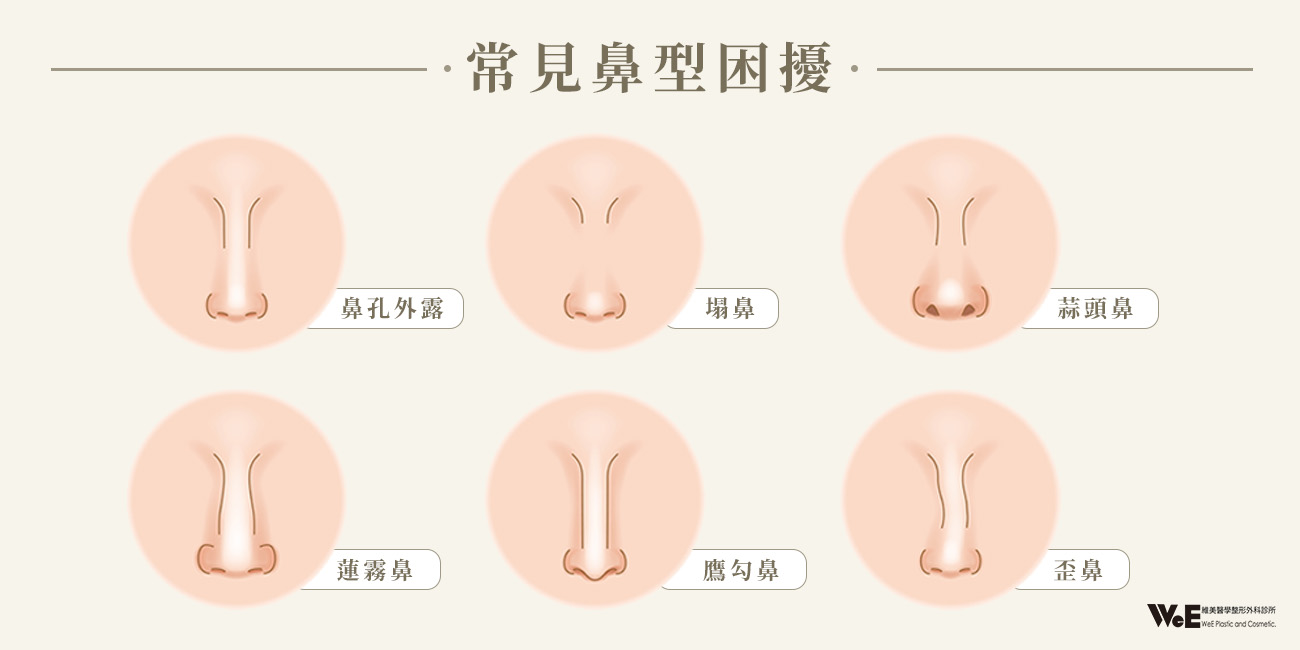 常見鼻型困擾