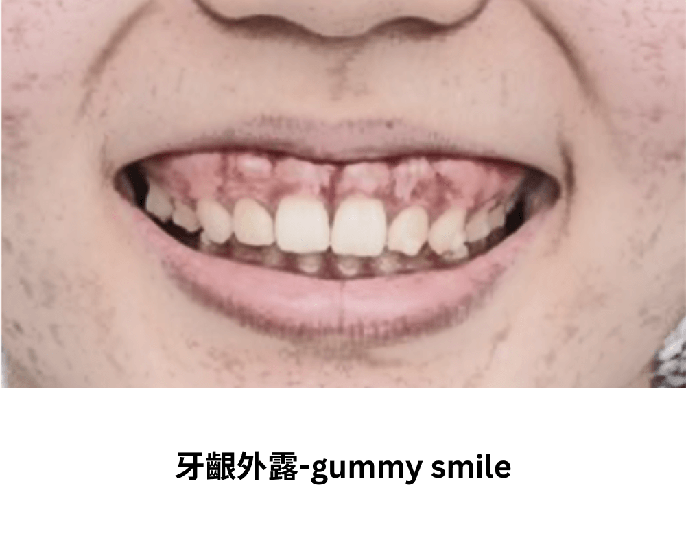 牙齦外露-gummy smile