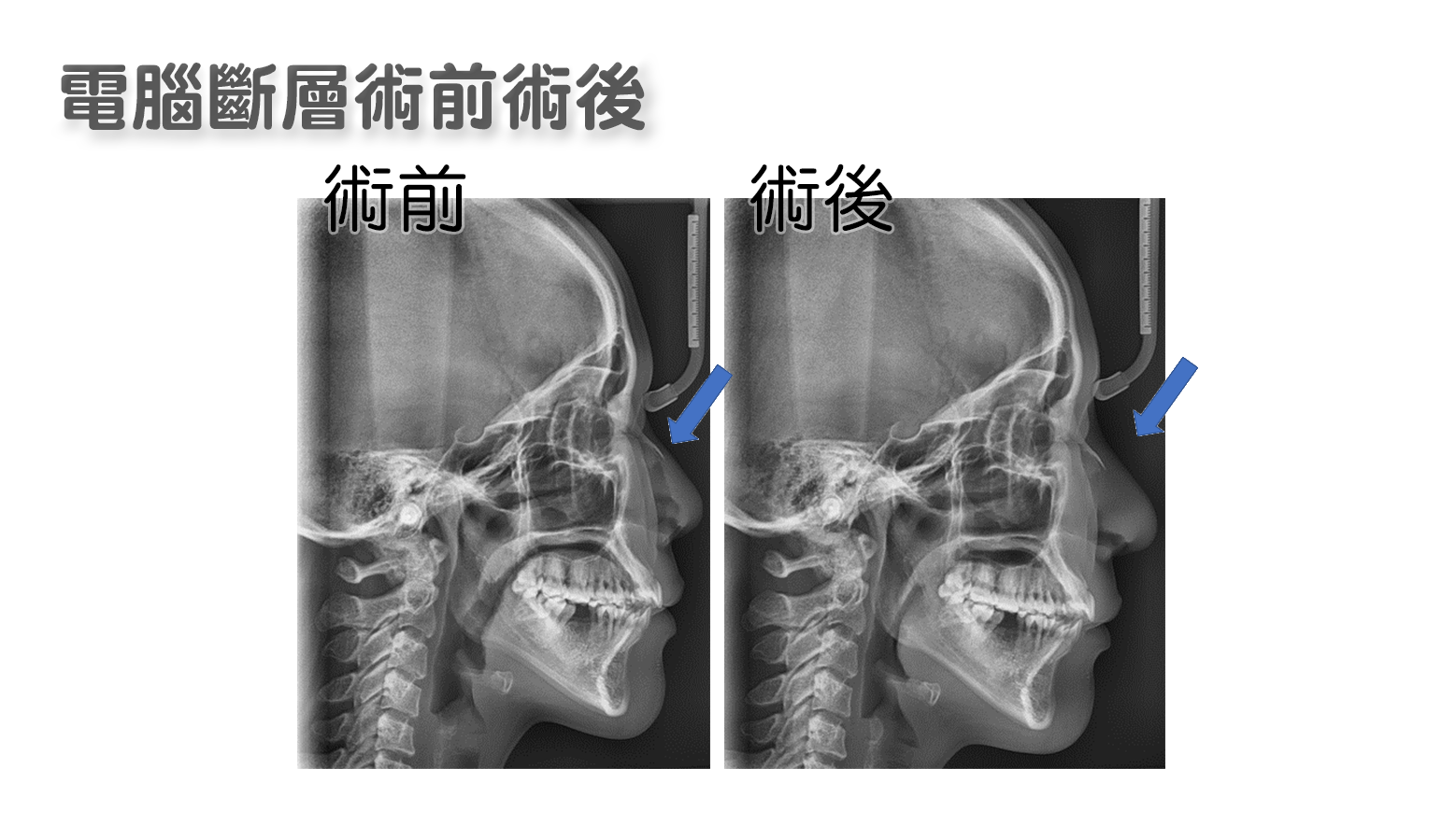 隆鼻電腦斷層檢查