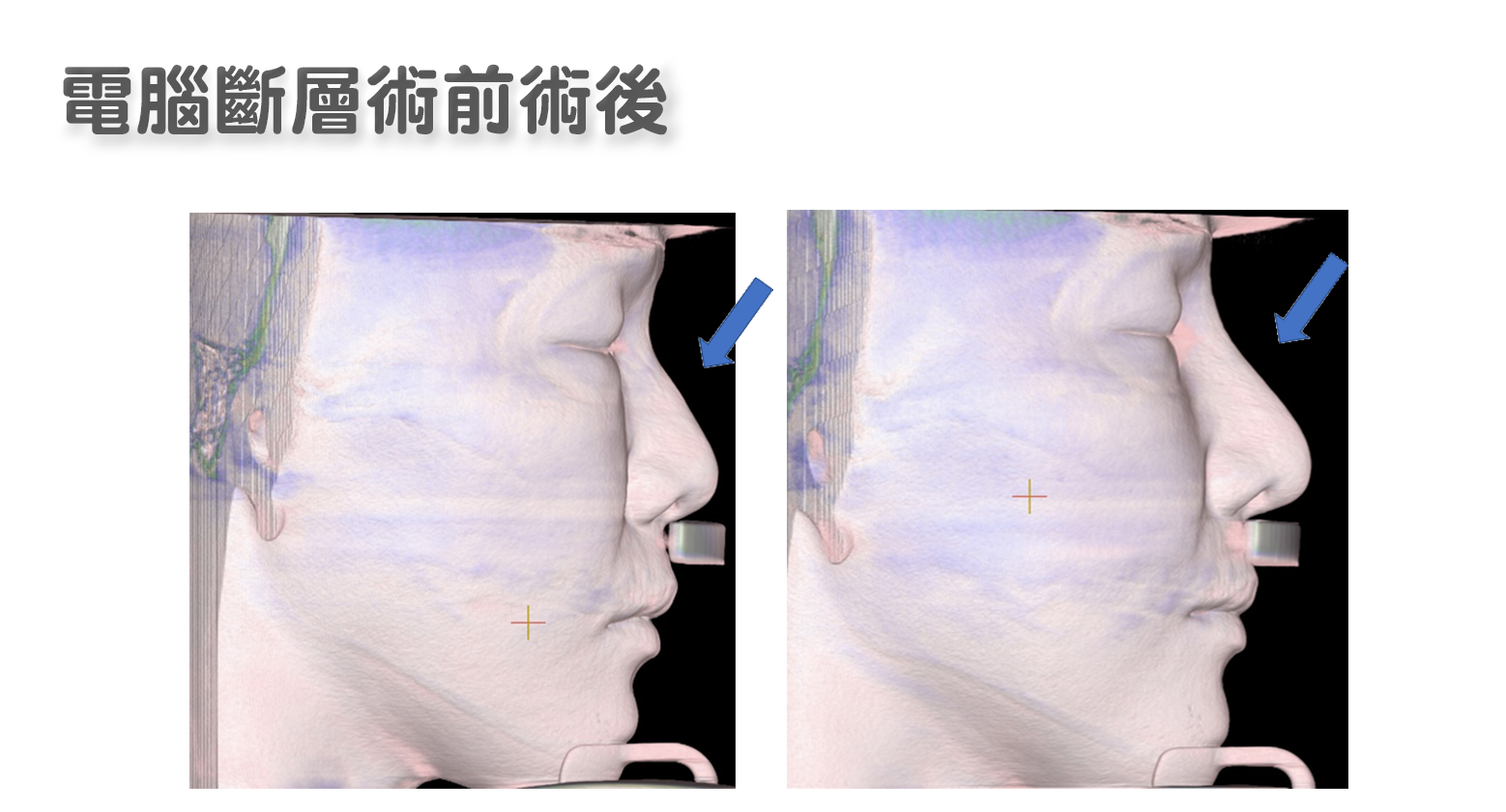 隆鼻術前術後電腦斷層