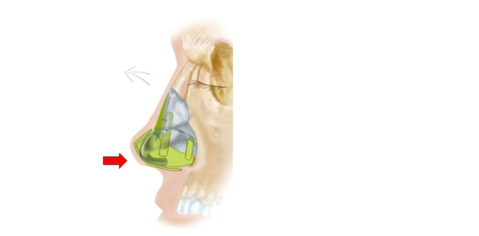 隆鼻-穩定鼻柱結構