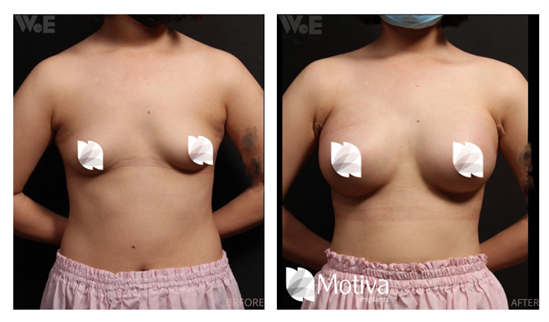 魔滴隆乳手術成功案例-3