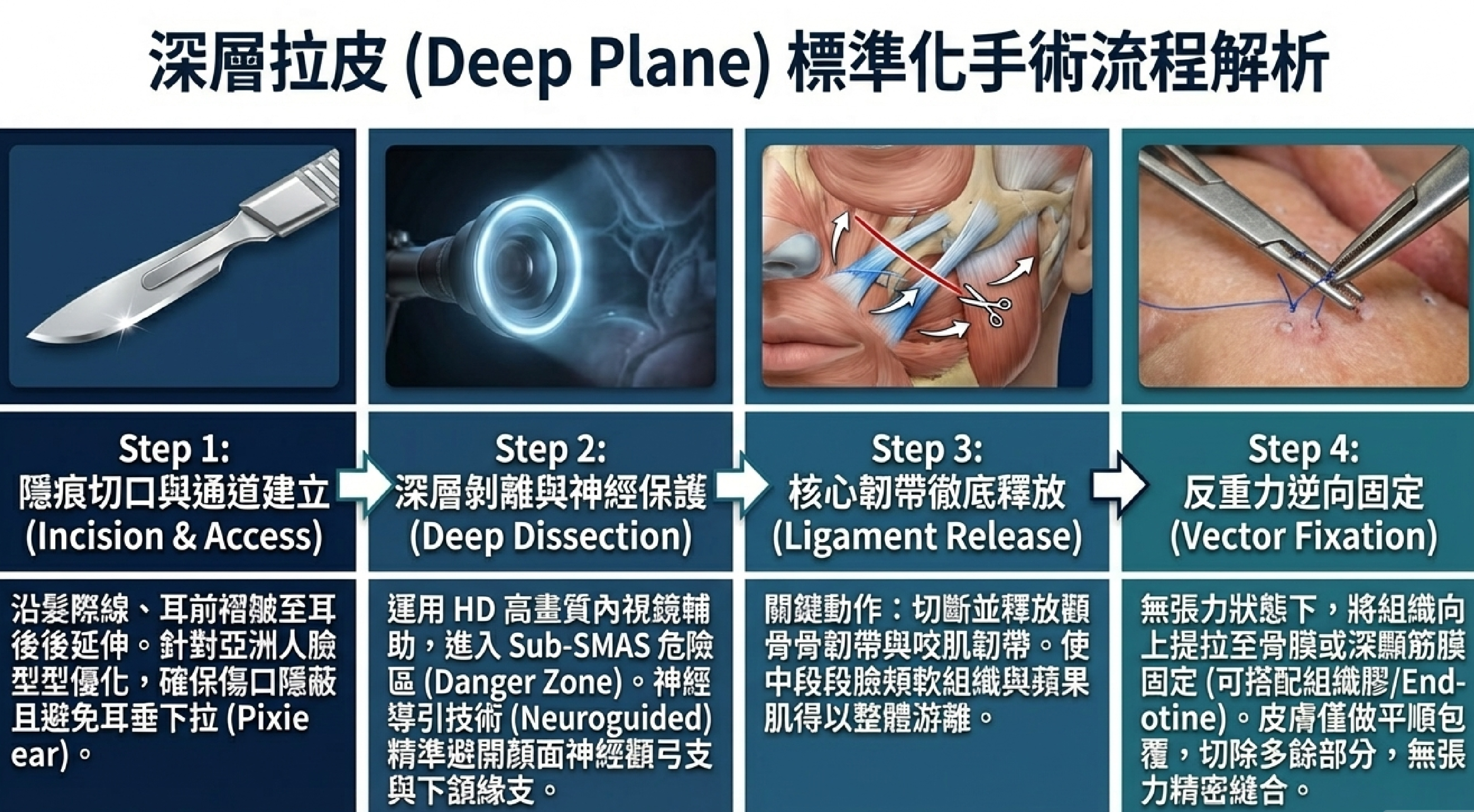 深層平面臉部拉皮手術標準化流程：切口設計、深層剝離、韌帶釋放、向量固定四大步驟