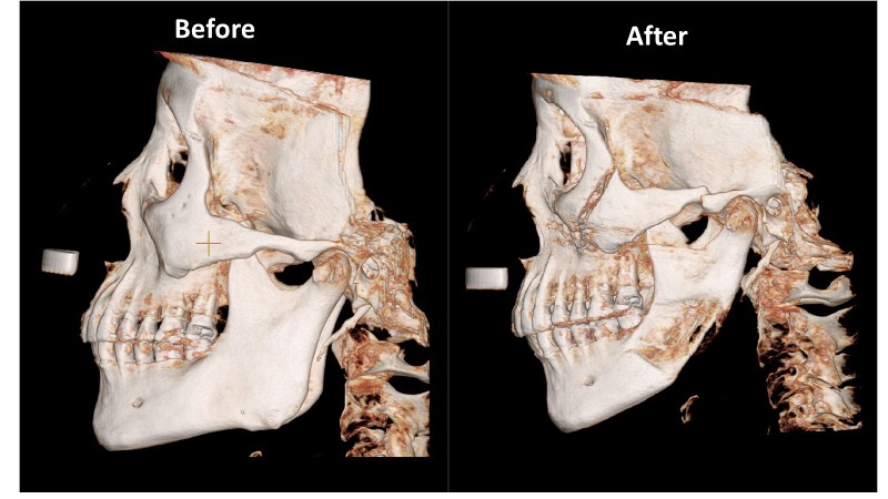 顴骨內推+下顎削骨