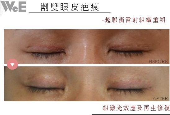 割雙眼皮疤痕以超脈衝雷射進行組織重塑:治療前後對照