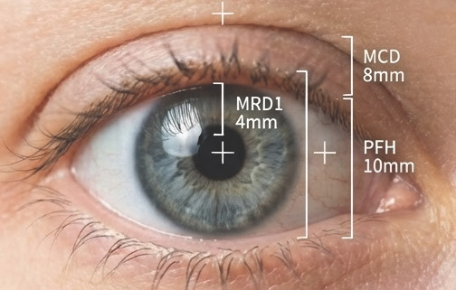 上瞼下垂臨床測量指標 MRD1 PFH MCD