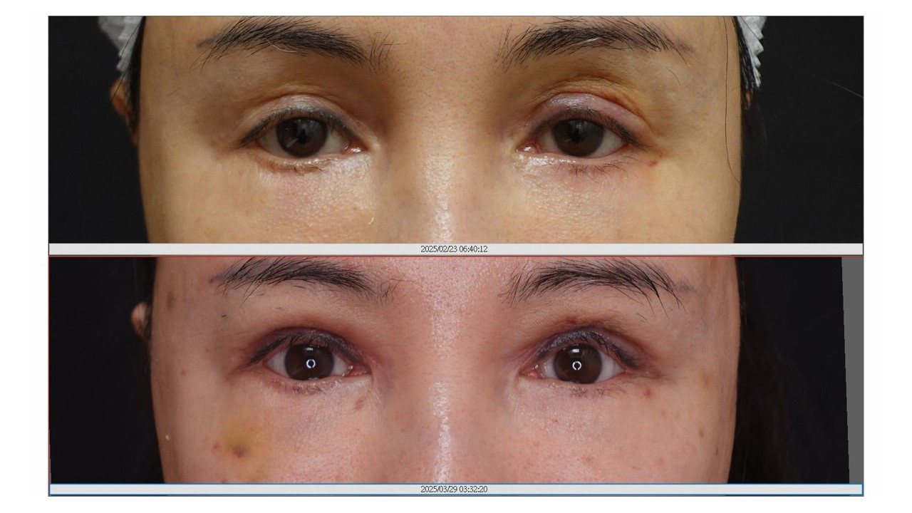 眼手術学〈2〉眼瞼