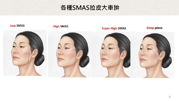 現代拉皮技術大比拼：各家醫師拉皮方法全面分析