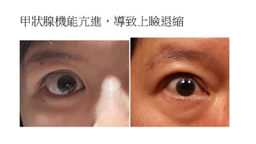 甲狀腺眼病變之上眼瞼退縮：甚麼是可預測且穩定的上瞼下壓矯正手術治療新選擇