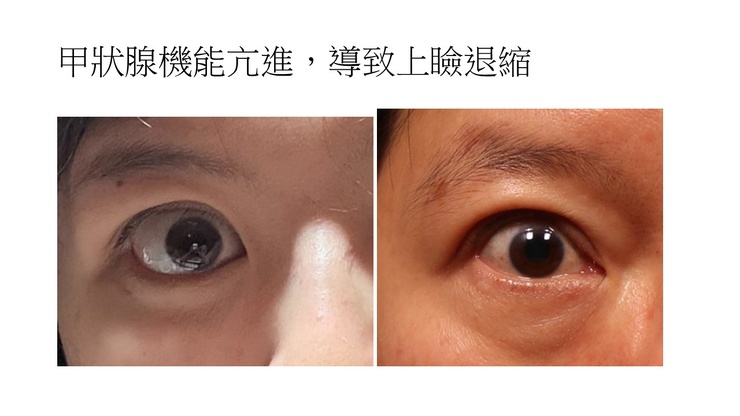 甲狀腺眼病變之上眼瞼退縮：甚麼是可預測且穩定的上瞼下壓矯正手術治療新選擇
