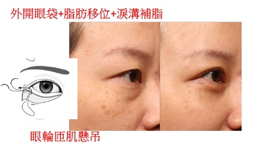 眼袋、淚溝、黑眼圈、蘋果肌下垂怎麼辦？完整解決方案，重塑您的年輕輪廓