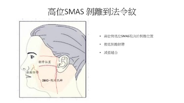面部拉皮手術完整指南：從淺層到深層的全方位年輕化解決方案，高位深層拉皮除手術:一次性真正年輕化，皮膚拉緊改善下垂臉，配合天鵝頸手術與頸紋治療效果更好