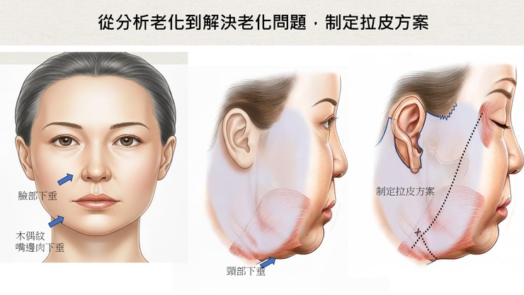 二次拉皮手術的真相：挑戰、技術與關鍵風險解析