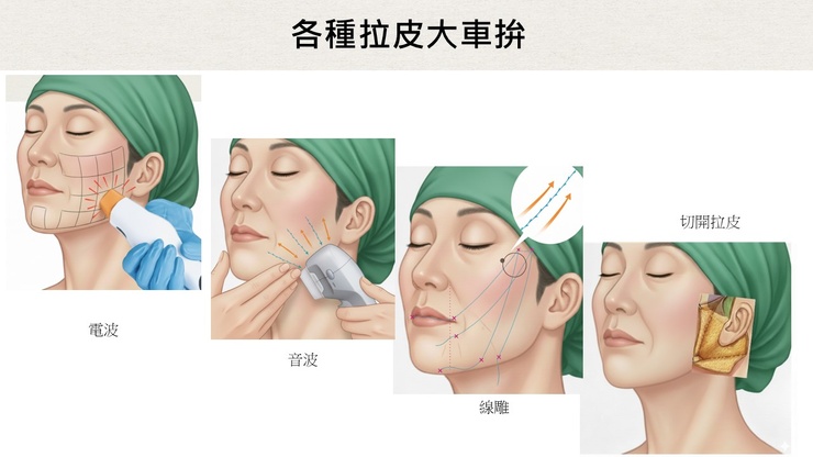 「手術式筋膜拉皮」「非手術埋線拉提」「電音波拉提」的差異