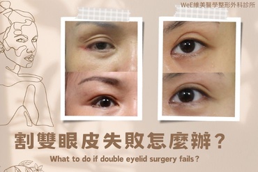 雙眼皮疤痕與雙眼皮重修發生原因?雙眼皮高改窄，寬深與肉條感要怎樣解決? 案例大公開