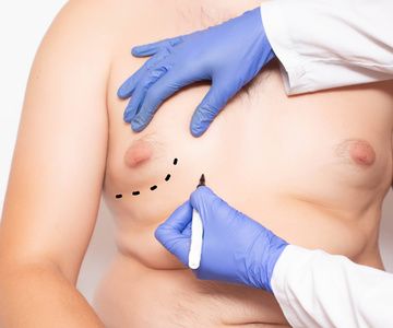 男性女乳手術