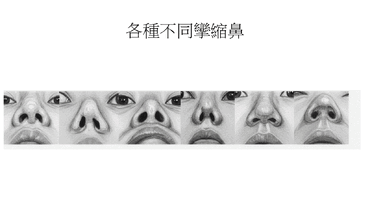 鼻子攣縮是什麼？隆鼻攣縮 5 級症狀對照、原因機率與能不能救