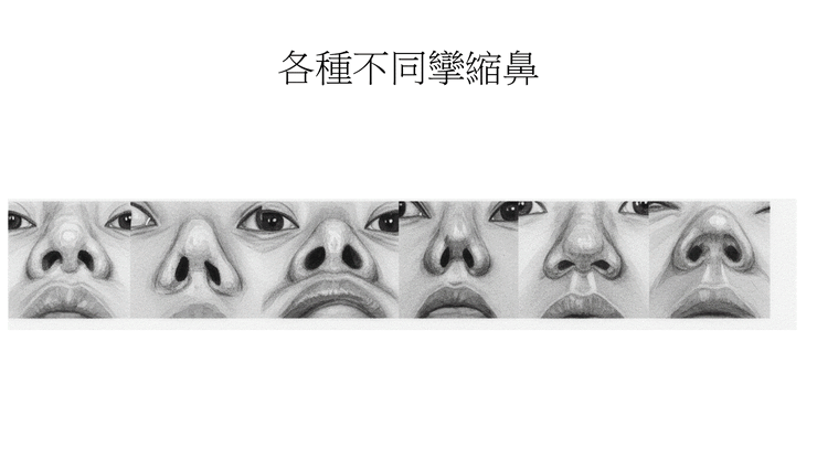 攣縮鼻的脂肪治療：綜合分析
