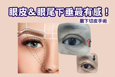 改善下垂眼皮｜眉下切皮｜眉切手術，不必五爪勾前額拉皮也可以讓雙眼皮好看