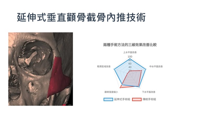 延伸式顴骨縮小內推術：革新顴骨面部輪廓整形治療優勢